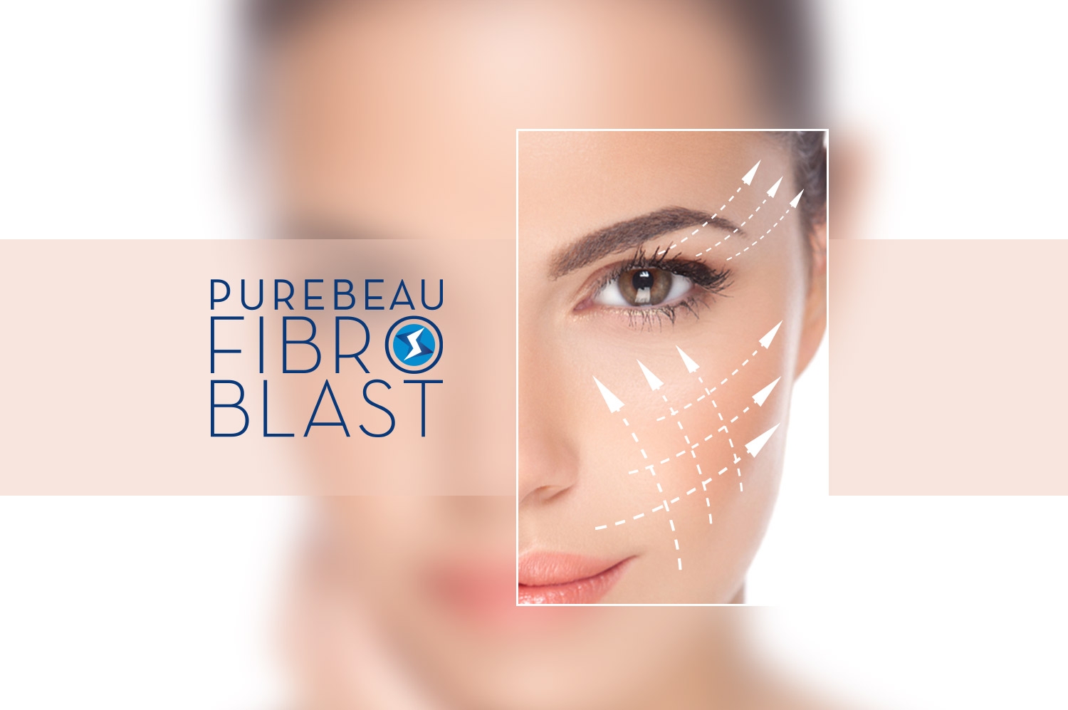 FIBROBLAST FIBROBLAST